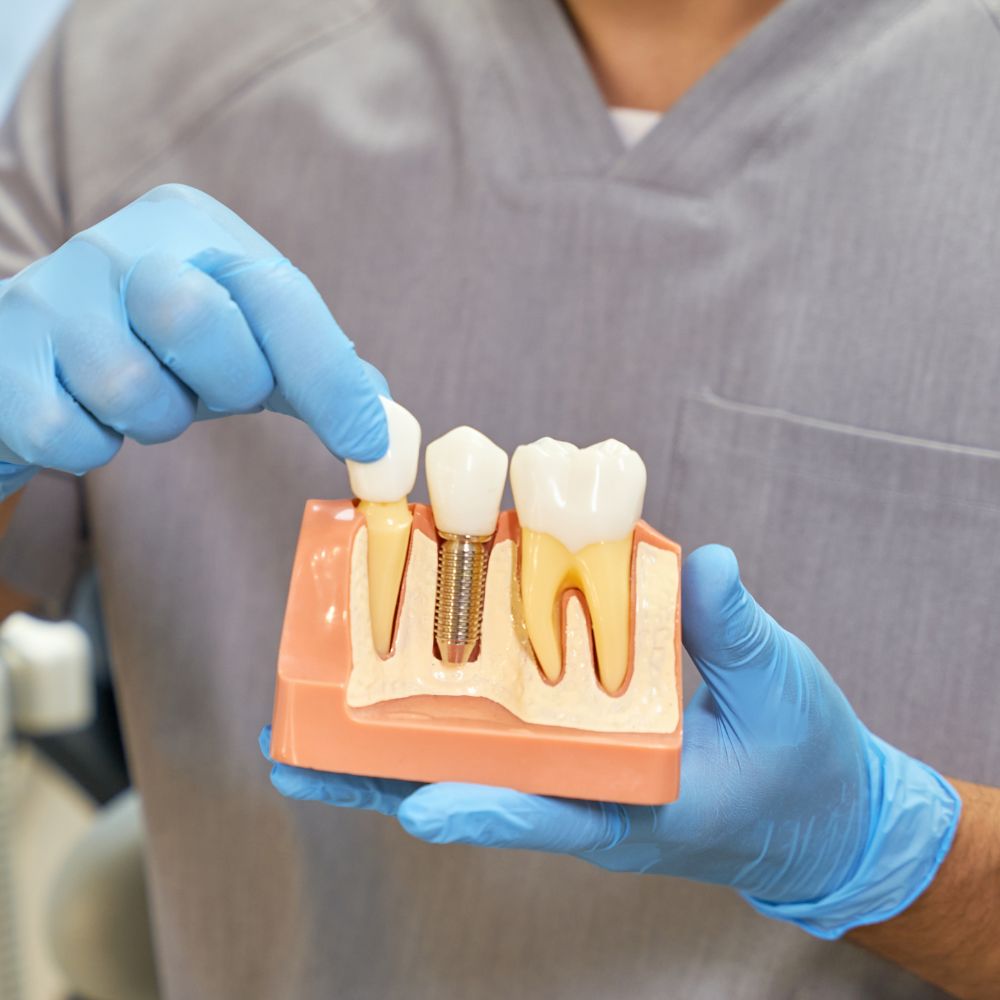 Dental Implants Powell